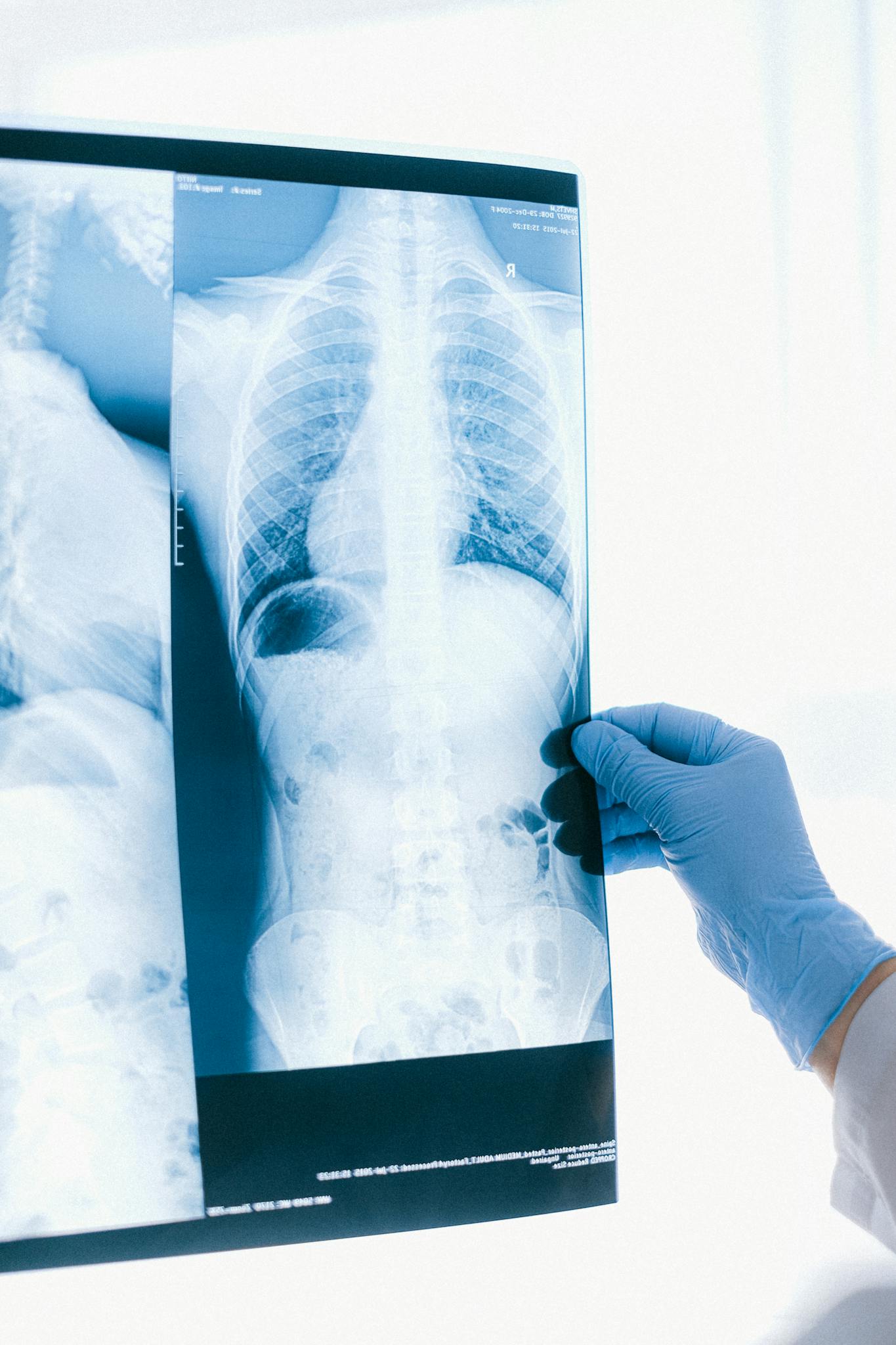 Medical professional in blue gloves analyzing a chest X-ray image indoors.